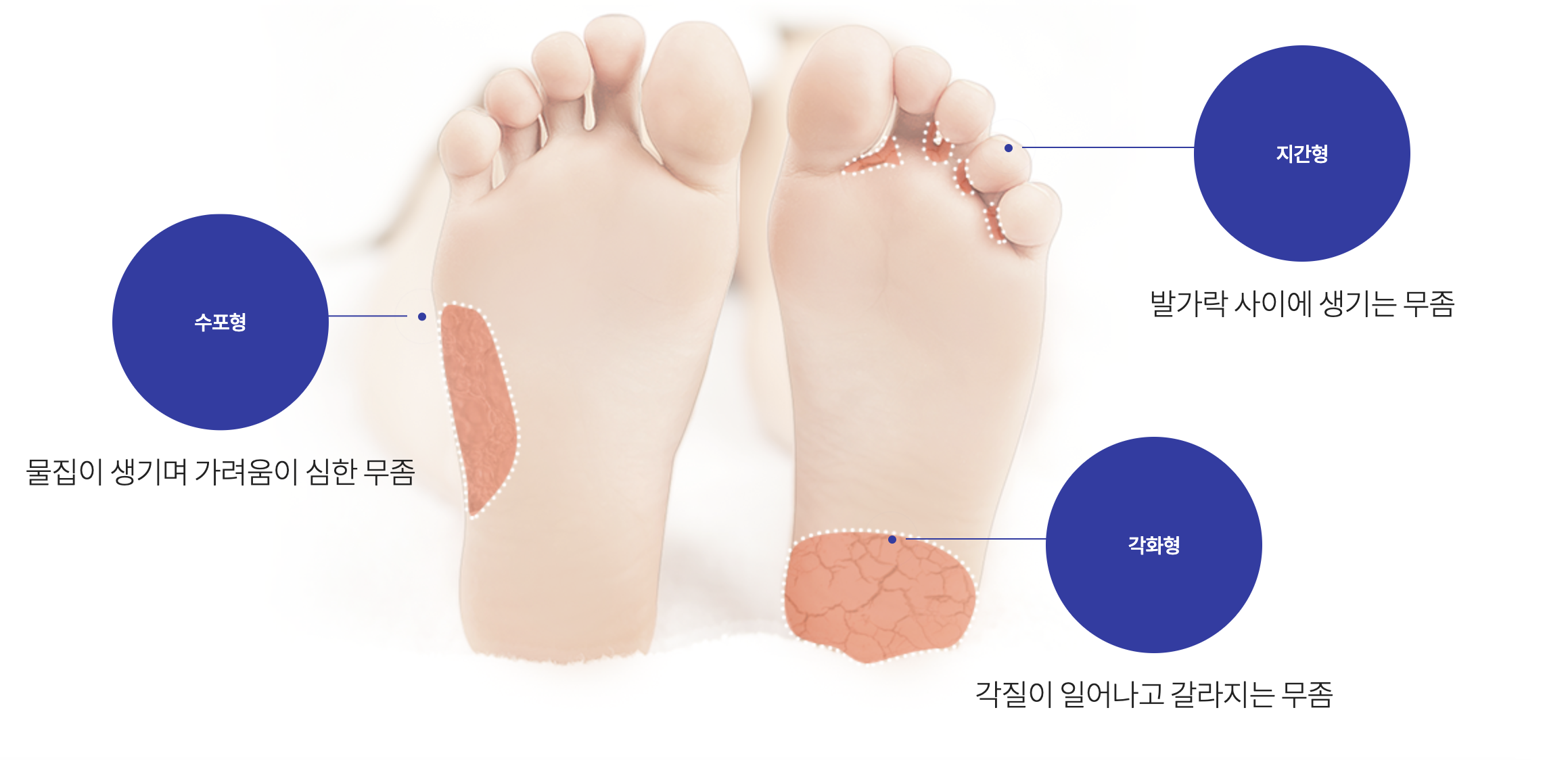무좀 예방법 자연 치유 안 돼요! 제대로 알고 관리하는 무좀 예방법 7가지 2 2. 무좀, 종류에 따라 증상이 달라요 출처 : 터비뉴겔