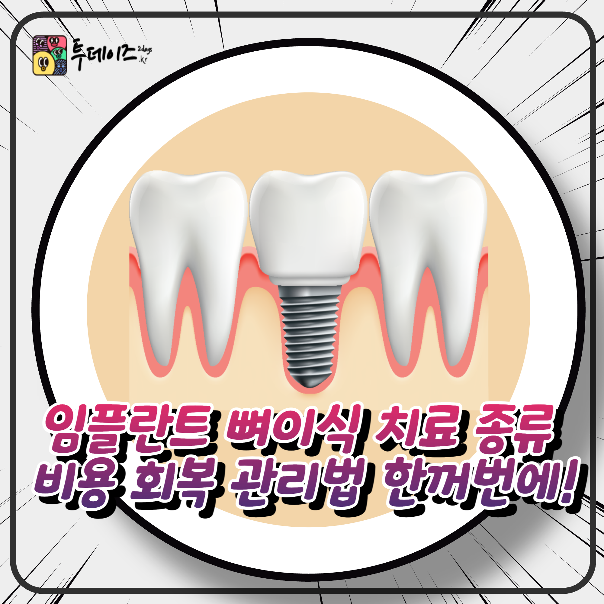 임플란트 뼈이식 치료 종류 비용 회복 관리법 한꺼번에! 임플란트 뼈이식 치료 종류 비용 회복 관리법 한꺼번에!