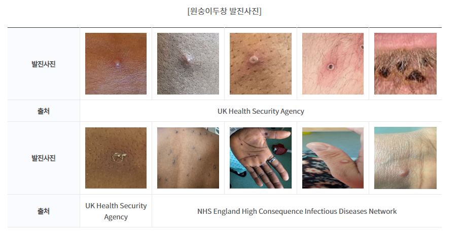 원숭이두창 감염경로 증상 다른 피부질환과 차이점 원숭이두창 감염경로 증상 다른 피부질환과 차이점