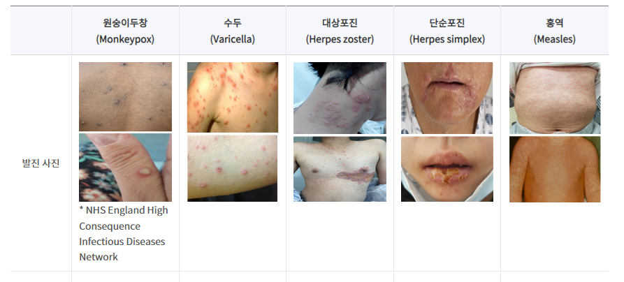 원숭이두창 감염경로 증상 다른 피부질환과 차이점 7 img 562